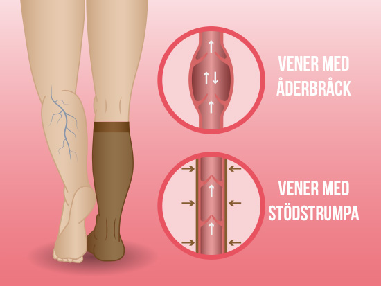 Stödstrumpor hjälper venerna